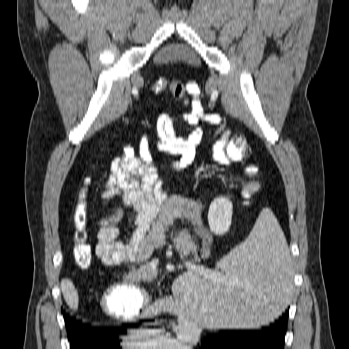 Coronal CT slice inside the SaroviX imaging agent