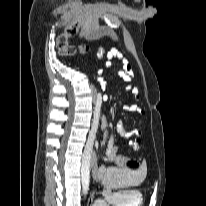 Sagittal CT slice inside the SaroviX imaging agent